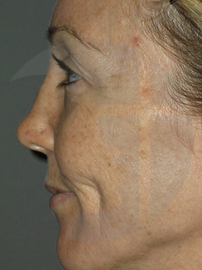 before fractional laser left view of female patient 1058