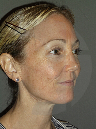 before fractional laser front view of female patient 1058