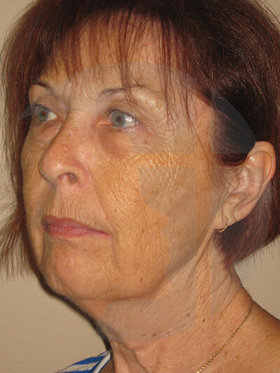 before fractional laser left angle view of female patient 1067