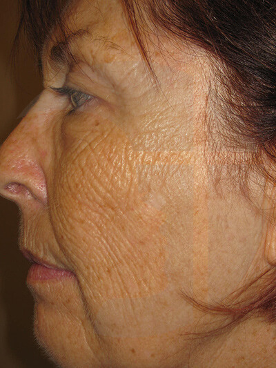 before fractional laser left view of female patient 1067