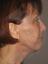 after fractional laser right view of female patient 1067