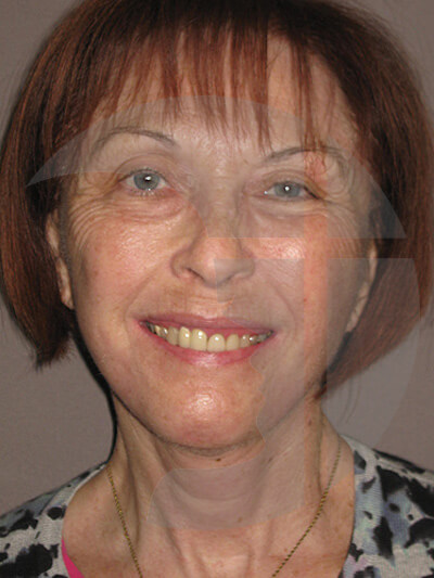 after fractional laser front view of female patient 1067