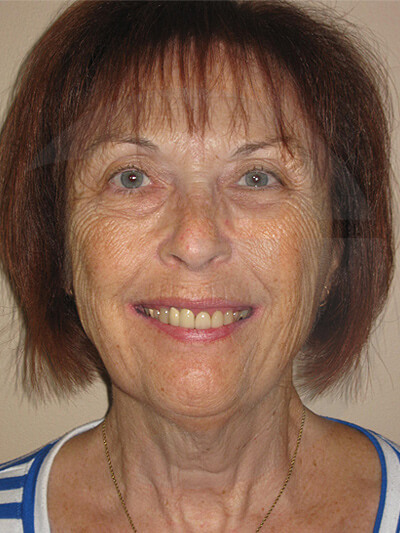 before fractional laser front view of female patient 1067