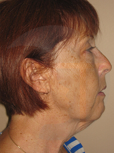 before fractional laser right view of female patient 1067
