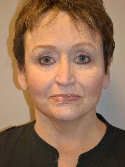 before fractional laser front view female patient case 1914