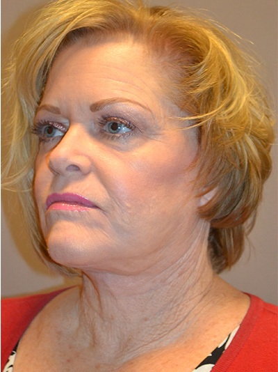 after fractional laser left angle view female patient case 1957