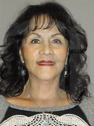 after neck lift front view of female patient 1104