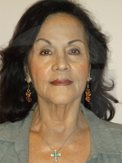 before neck lift front view of female patient 1104