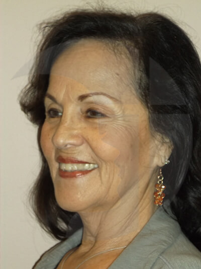 before neck lift left angle view of female patient 1104