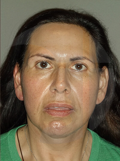 after neck lift front view of female patient 1120