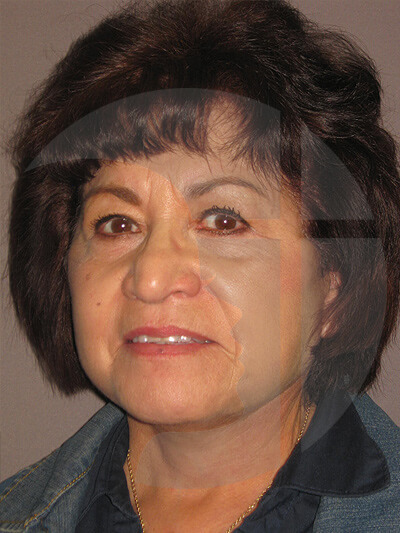 after neck lift left angle view of female patient 1125