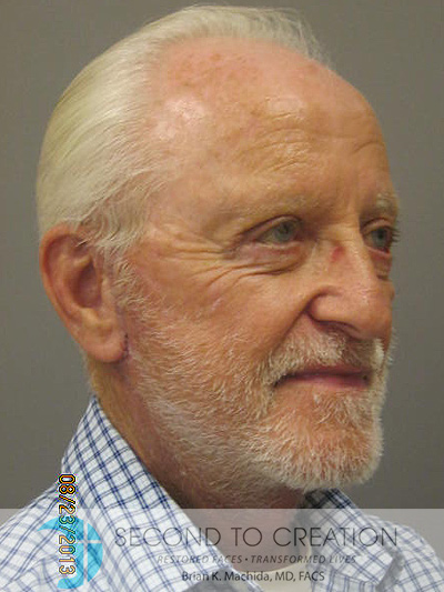 after neck lift right angle view of male patient 1132