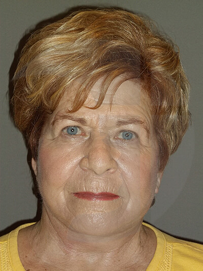 after neck lift front view of female patient 1140