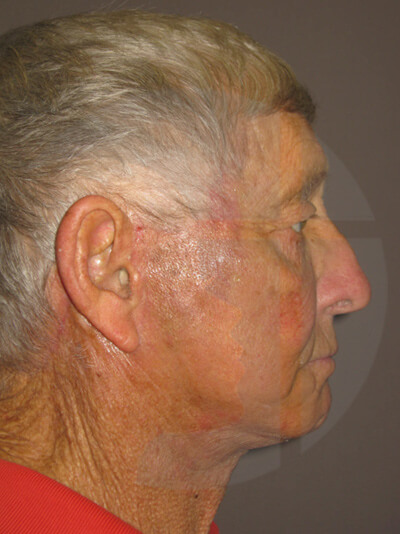 after neck lift right side view of male patient 1145