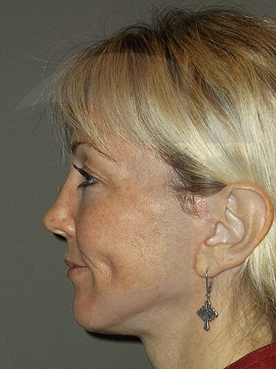 after neck lift left side view of female patient 1152