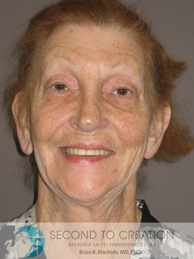 before neck lift front view of female patient 1161