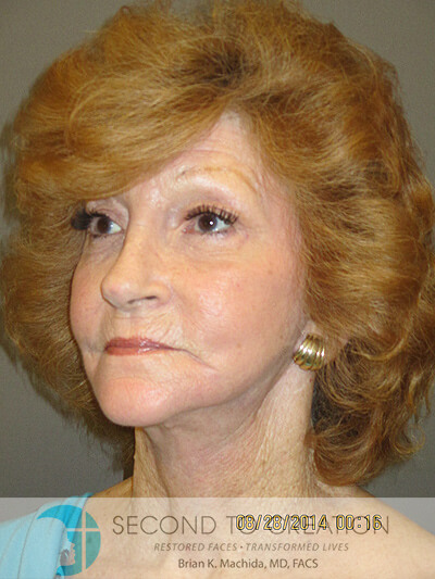 after neck lift right angle view of female patient 1161