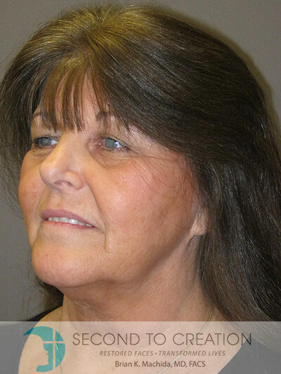 before neck lift left angle view of female patient 1166