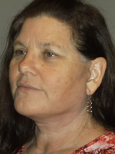 after neck lift angle view of female patient 14