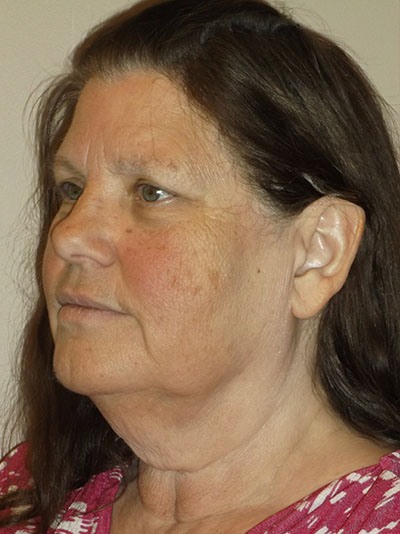 before neck lift angle view of female patient 14