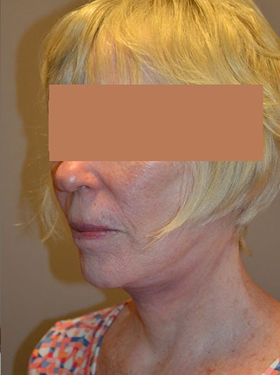 after neck lift angle view of female patient 1653