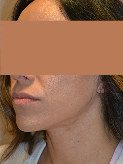 after neck lift angle view of female patient 1659