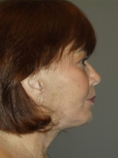 after neck lift right side view of female patient 1710