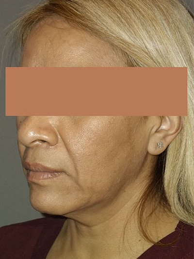 before neck lift left angle view of female patient 1748