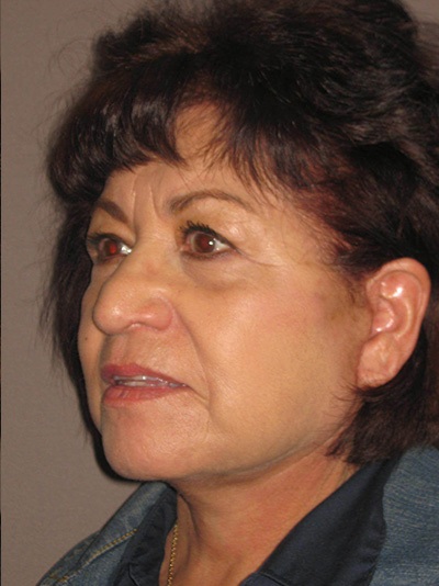 after neck lift left angle view of female patient 1855