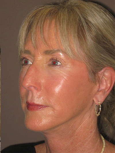 after neck lift left angle view of female patient 1863