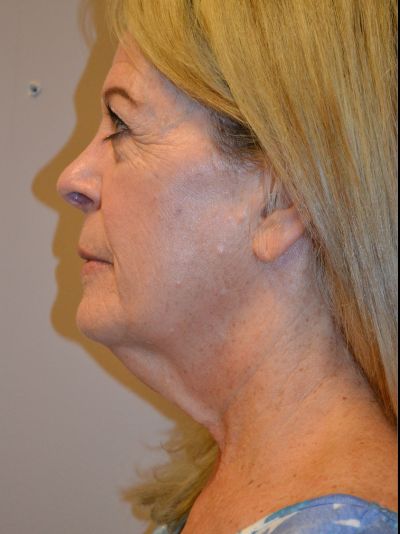before neck lift left side view female patient case 43