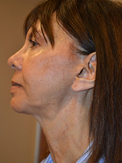 before neck lift left side view female patient case 46