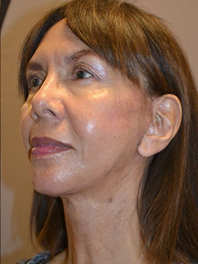 after neck lift left angle view female patient case 46