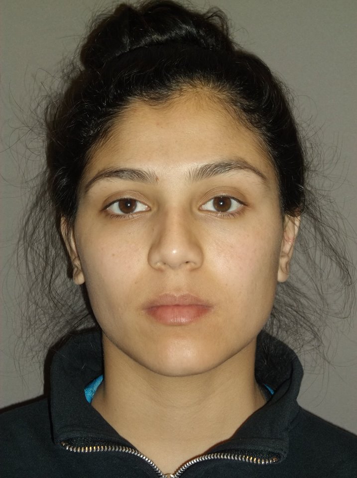 after otoplasty front view of female patient 1358