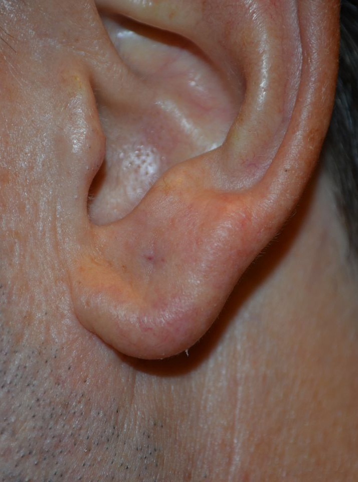 after otoplasty left side view of patient 1814