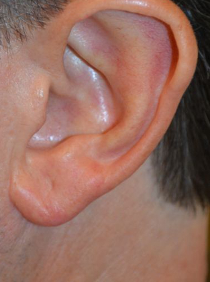 before otoplasty left side view of patient 1814