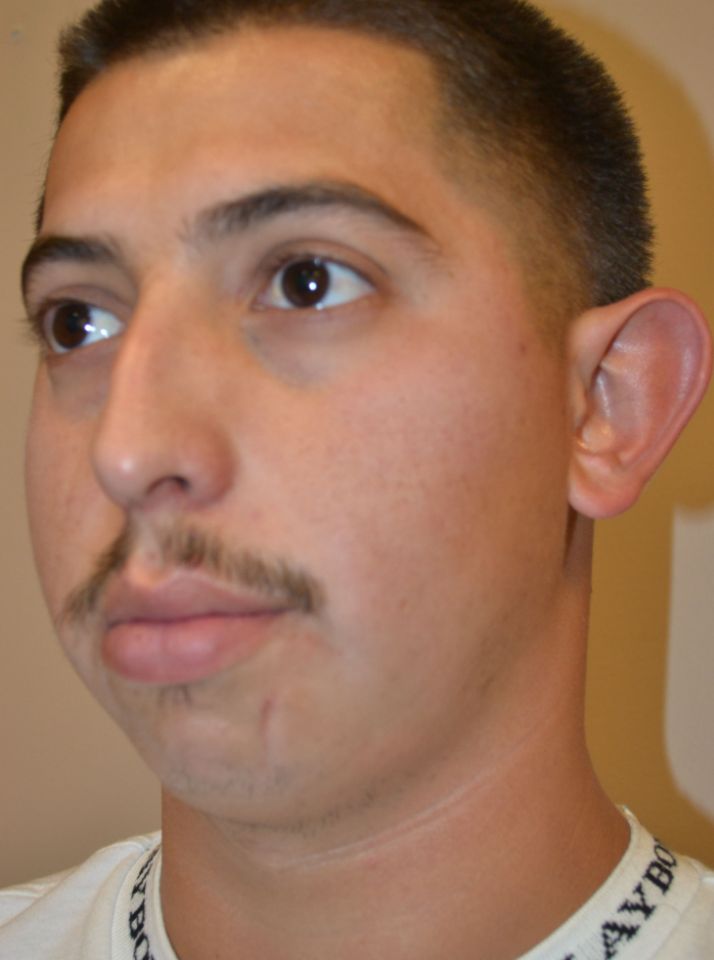 before otoplasty left angle view male patient case 2221