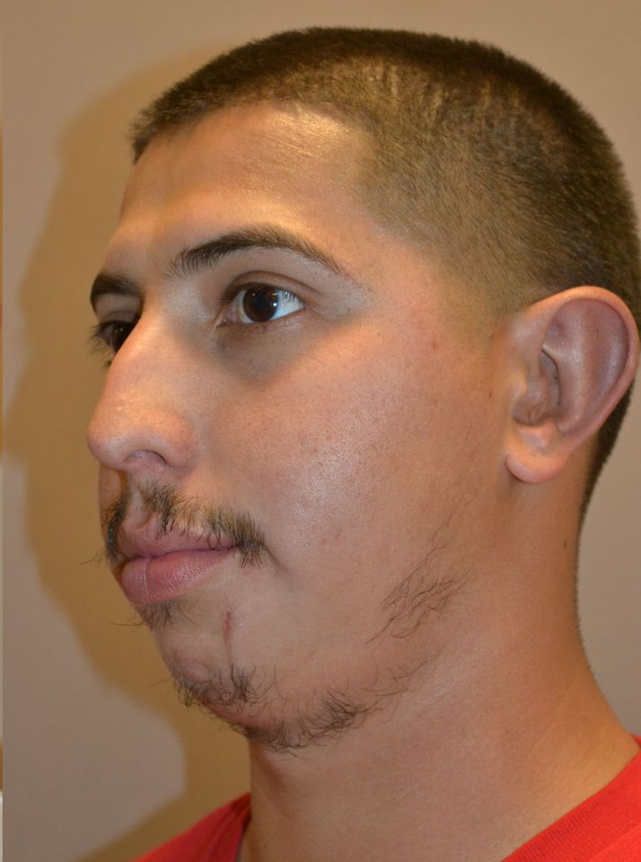 after otoplasty left angle view male patient case 2221