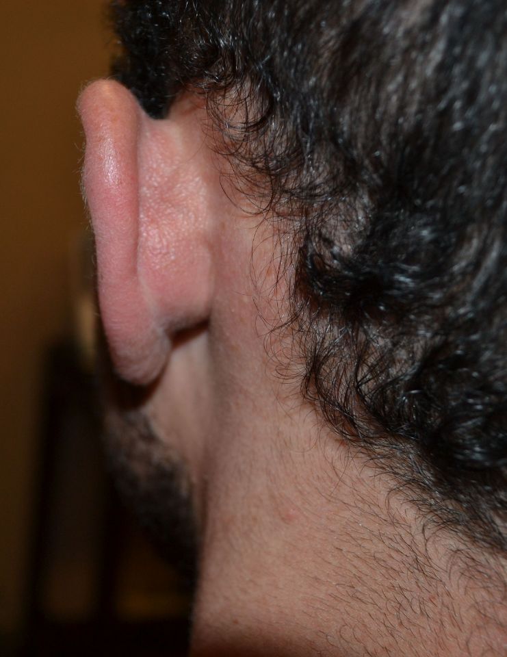 before otoplasty back view male patient case 2224