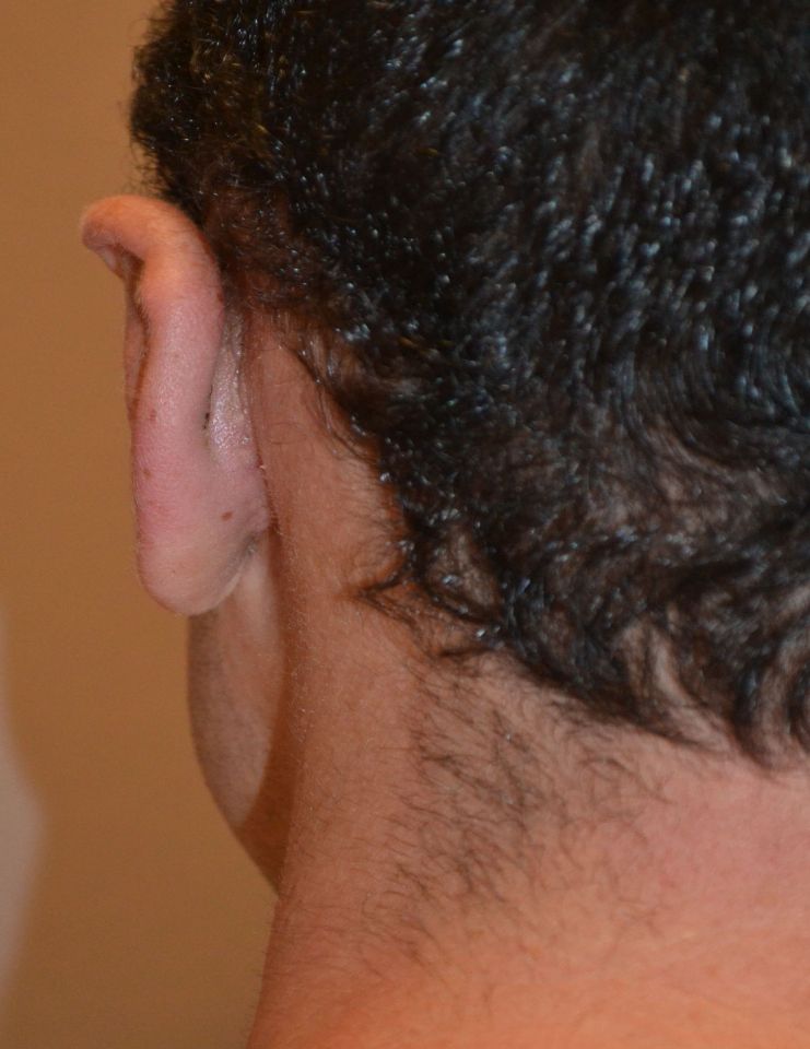 after otoplasty back view male patient case 2224