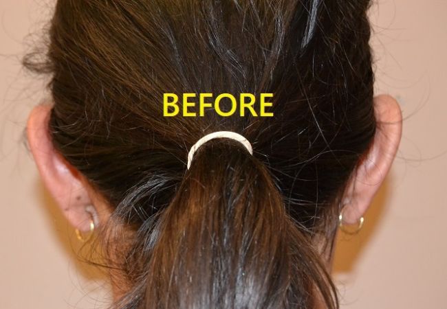 before otoplasty front view female patient case 2675