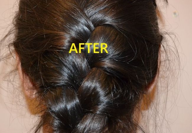 after otoplasty front view female patient case 2675